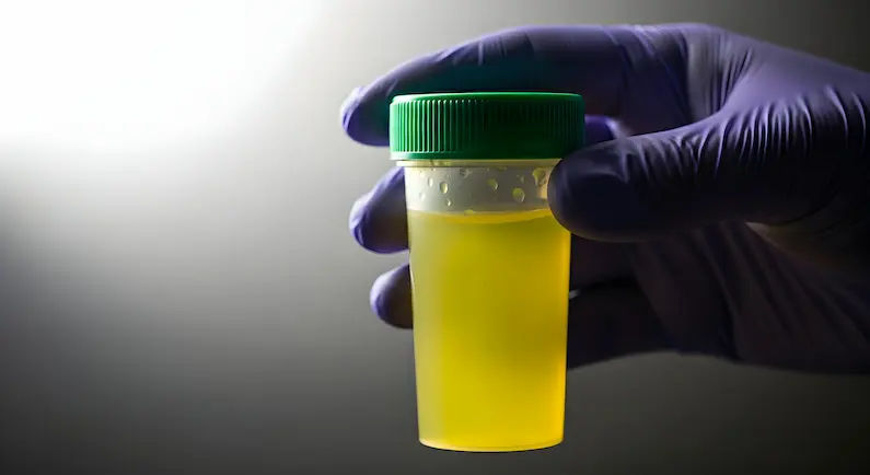 Dark Yellow Urine Causes and Indications